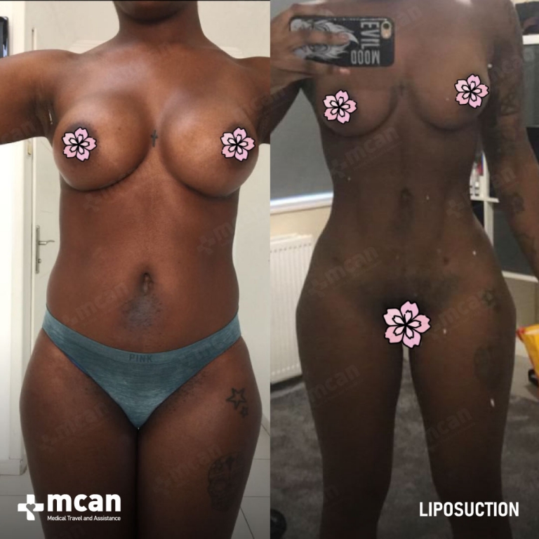 Liposuction Before & Afters 1