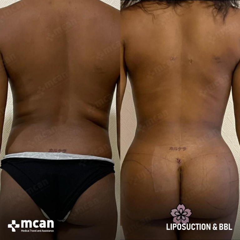 Liposuction Before & Afters 1