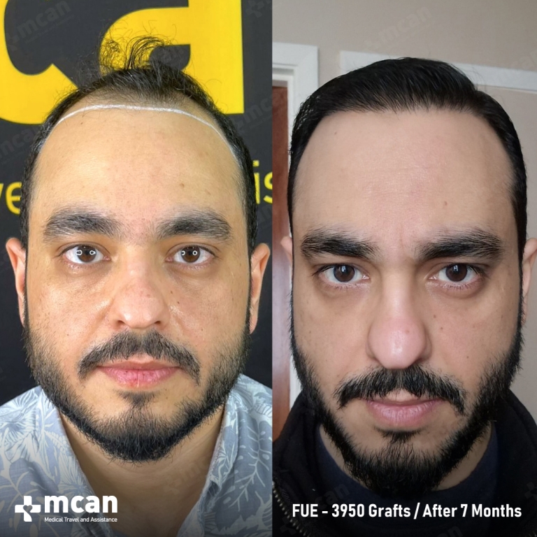 Mukhtar M. Before and After
