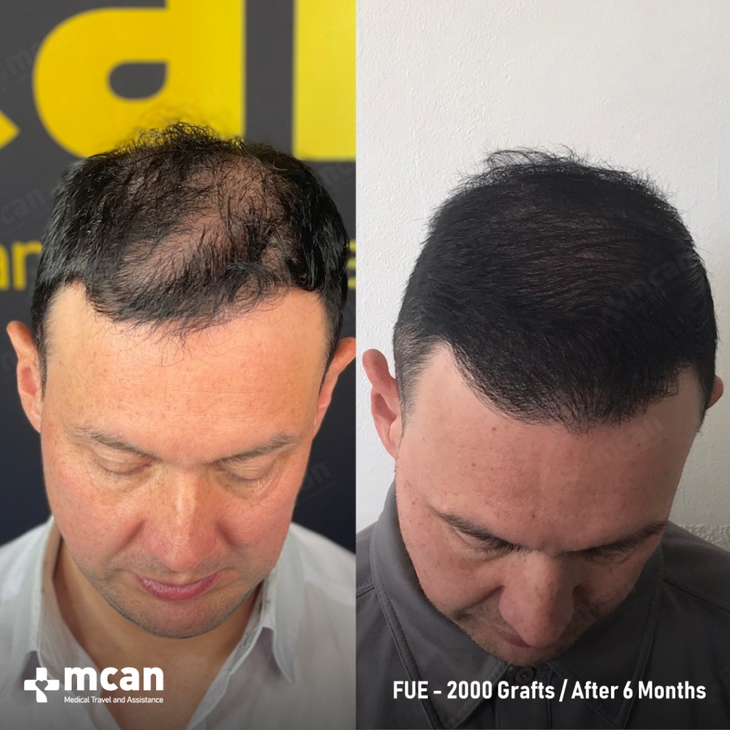 hair transplant before and after photo of mcan health 