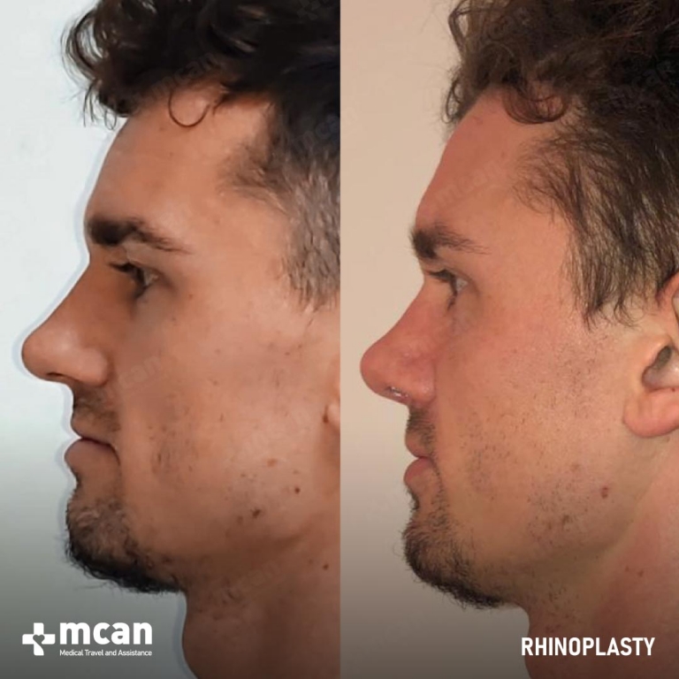 Rhinoplasty Before & Afters 1