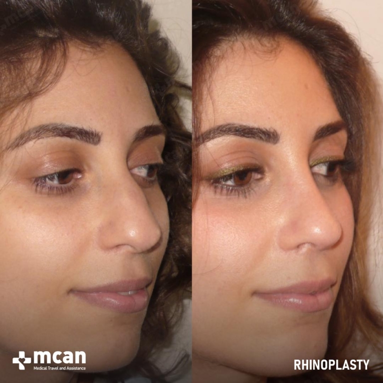 Rhinoplasty Before & Afters 1