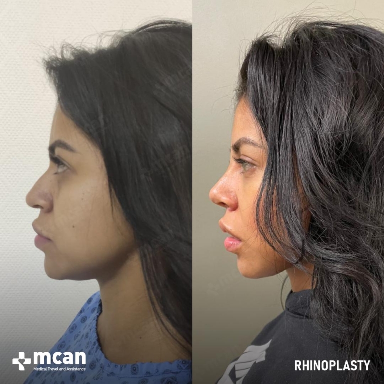 Rhinoplasty Before & Afters  2