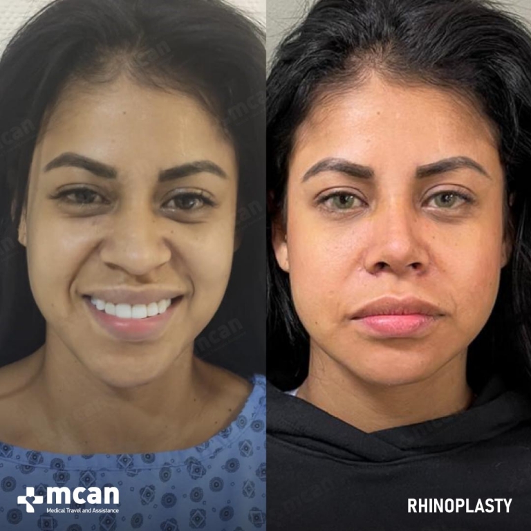 Rhinoplasty Before & Afters  1