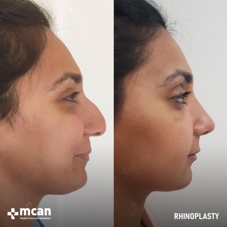 Rhinoplasty Before & Afters 1