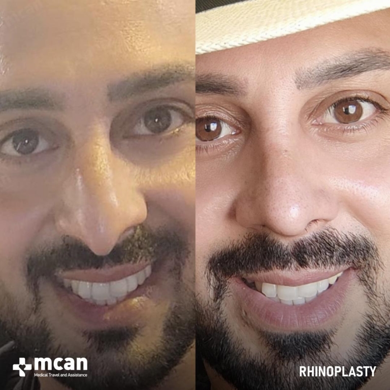 Rhinoplasty Before & Afters 1