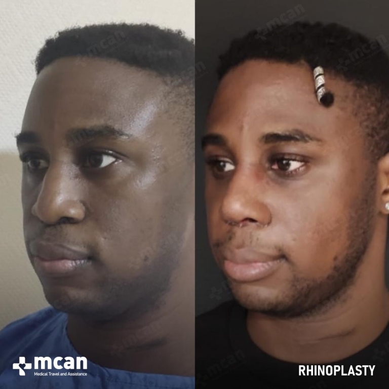 Rhinoplasty Before & Afters 1