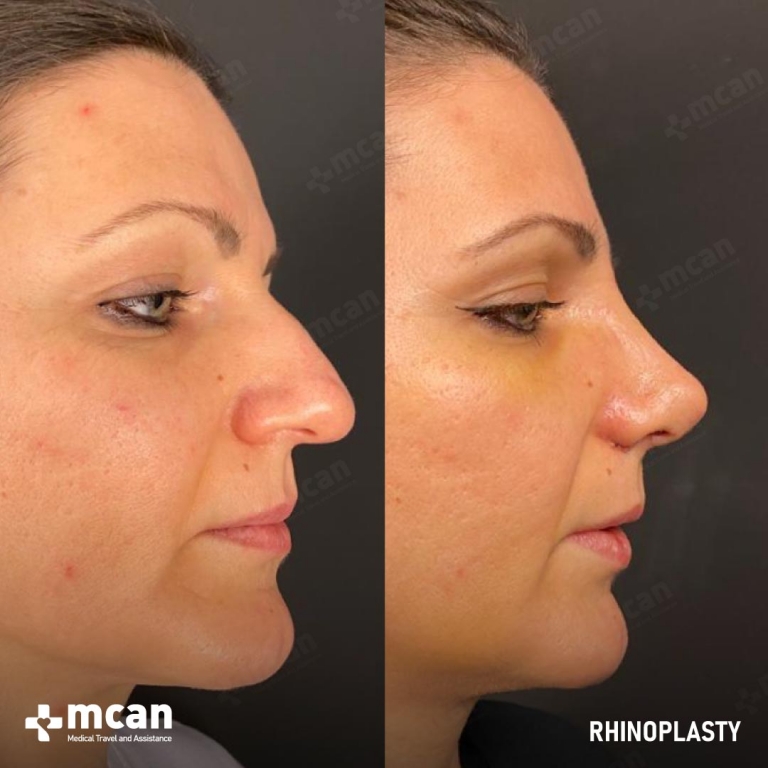 Rhinoplasty Before & Afters 1