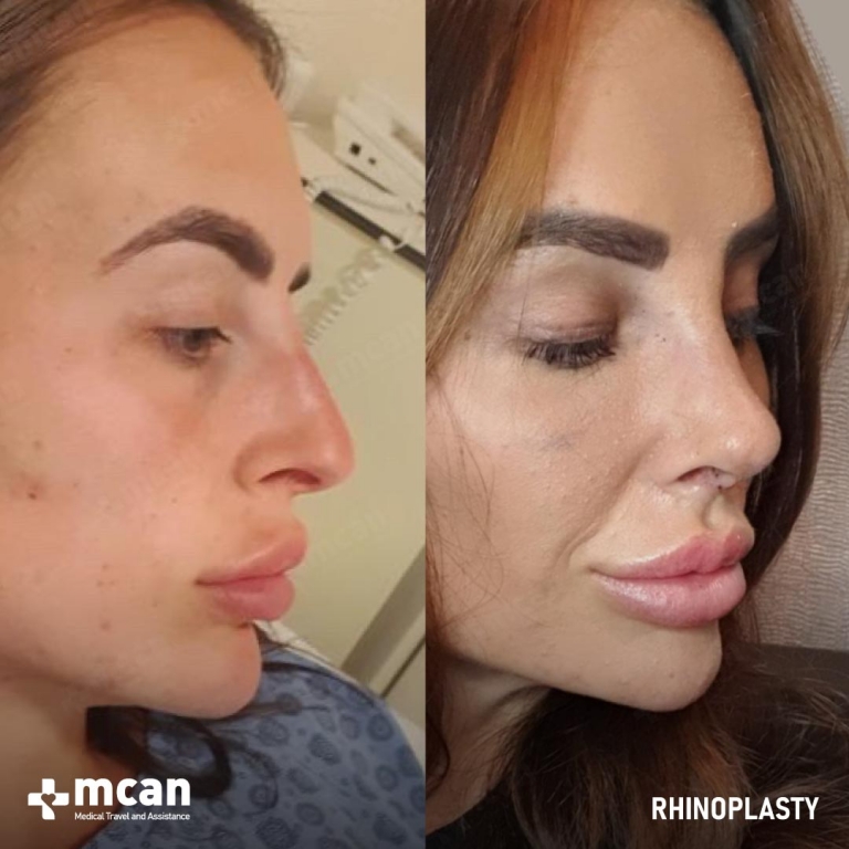 Rhinoplasty Before & Afters 1