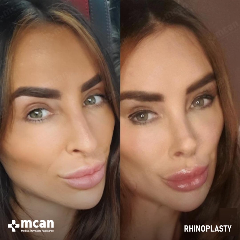 Rhinoplasty Before & Afters 1