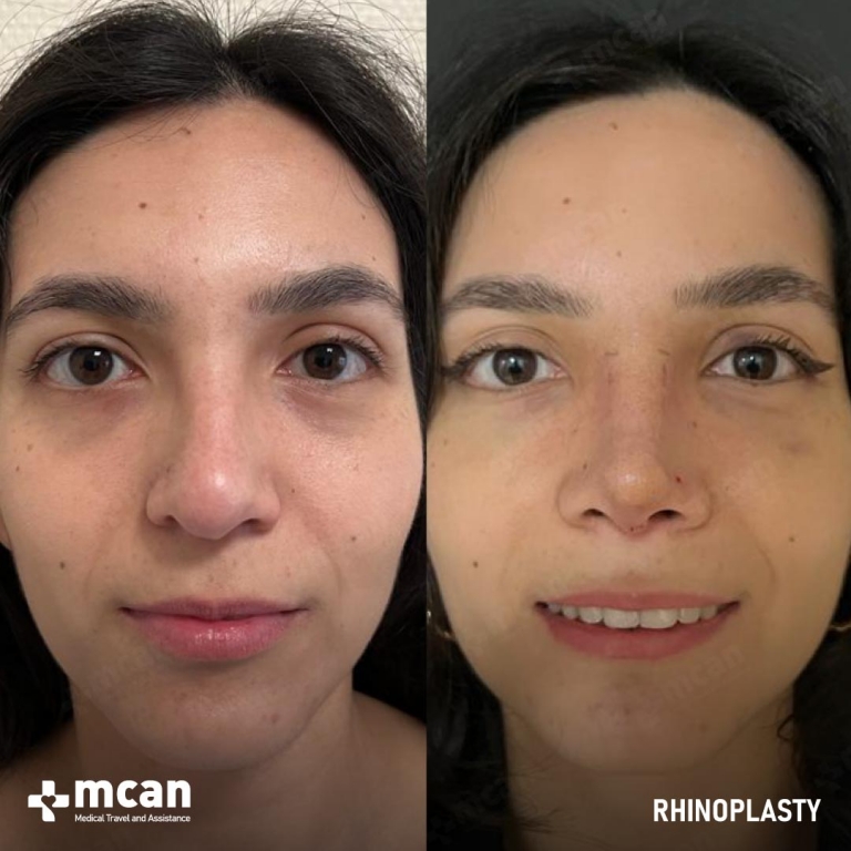 Rhinoplasty Before & Afters 1