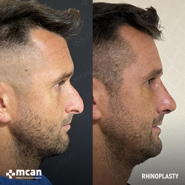 Rhinoplasty Before & Afters 1