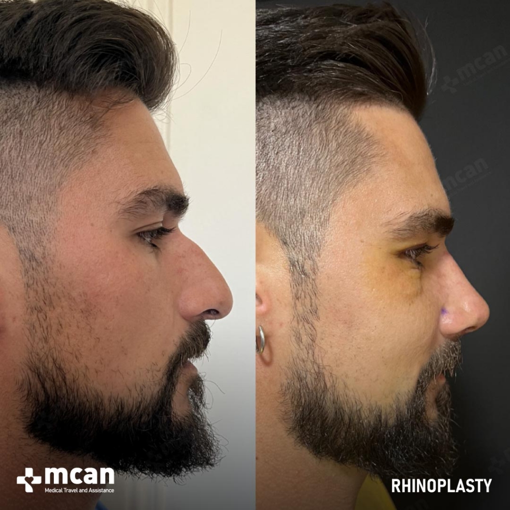 Rhinoplasty Nose Job Before After 30
