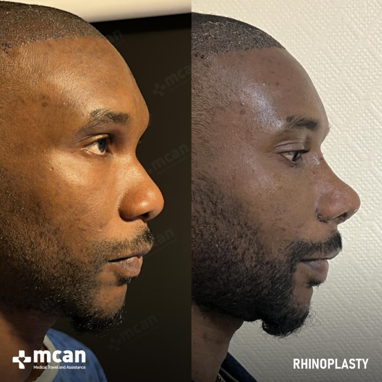 Rhinoplasty Before & Afters 1