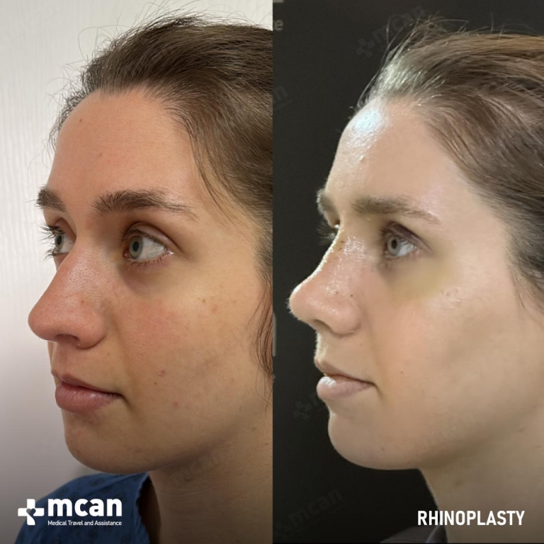 Rhinoplasty Before & Afters 1