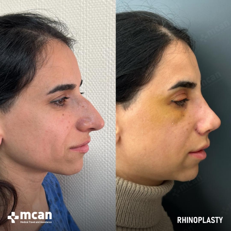 Rhinoplasty Before & Afters 1