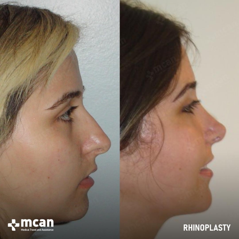 Rhinoplasty Before & Afters 1