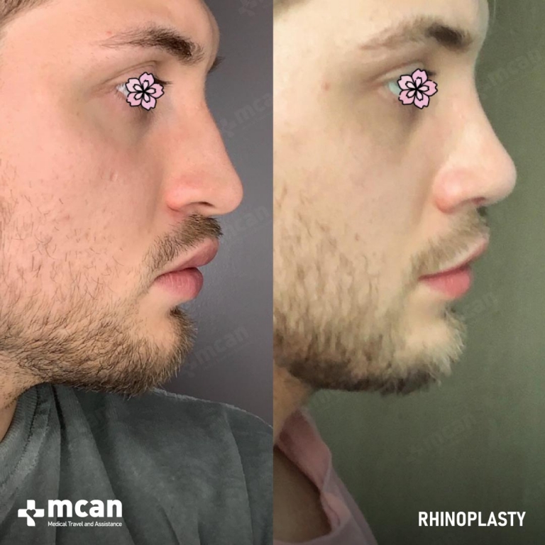 Rhinoplasty Before & Afters 1