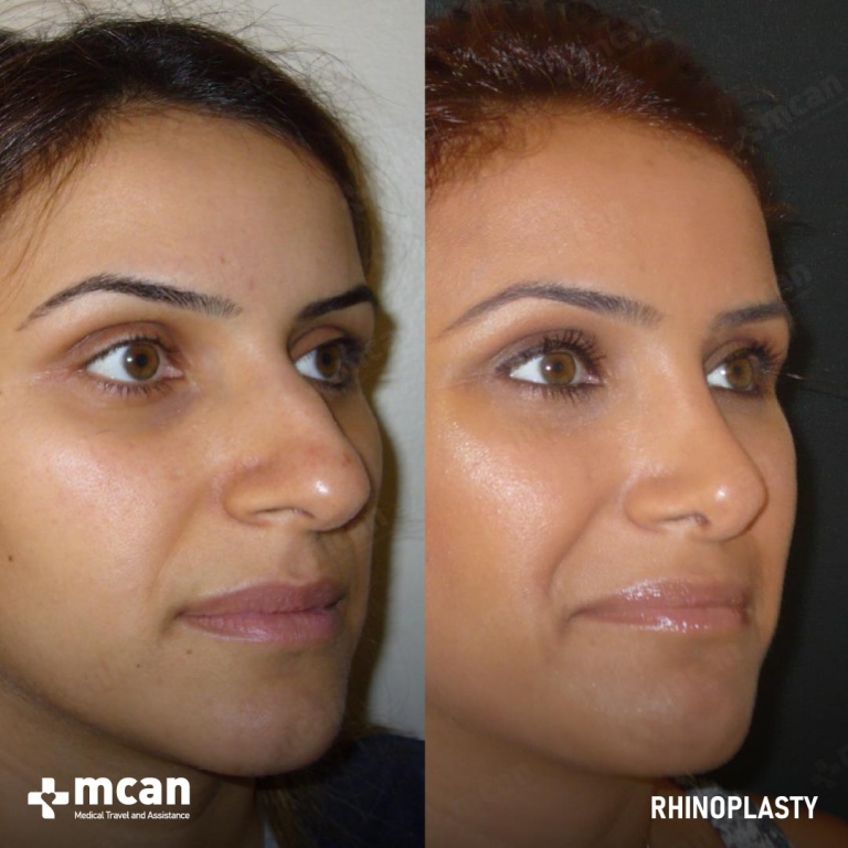 Rhinoplasty Before & Afters 1