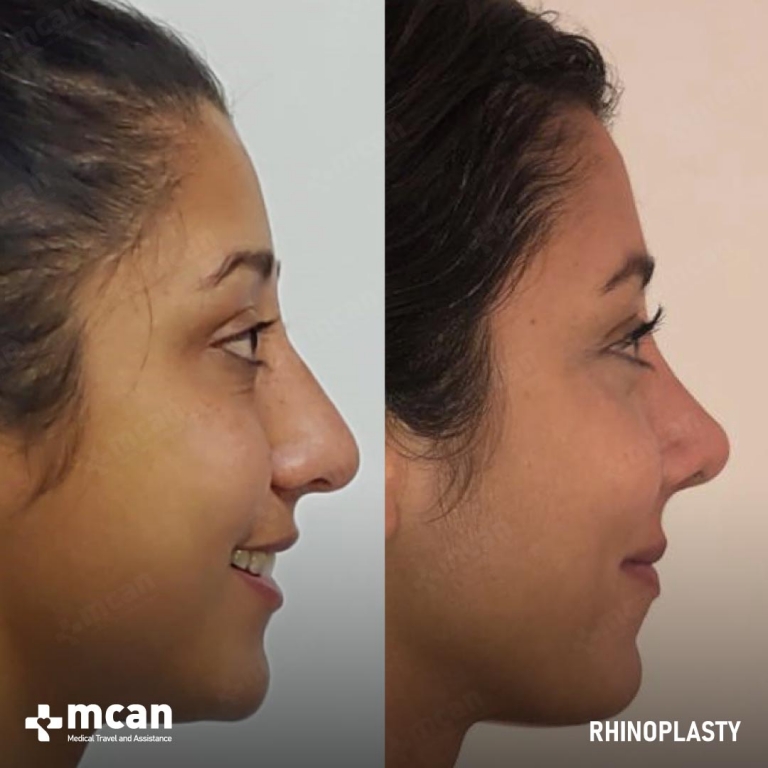 Rhinoplasty Before & Afters 1