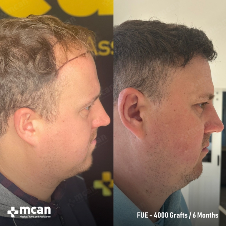 FUE Hair Transplant Before & Afters 4000 Grafts 2