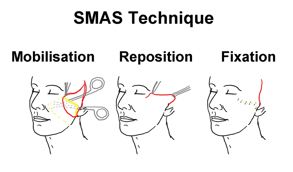 SMAS facelift vs deep plane