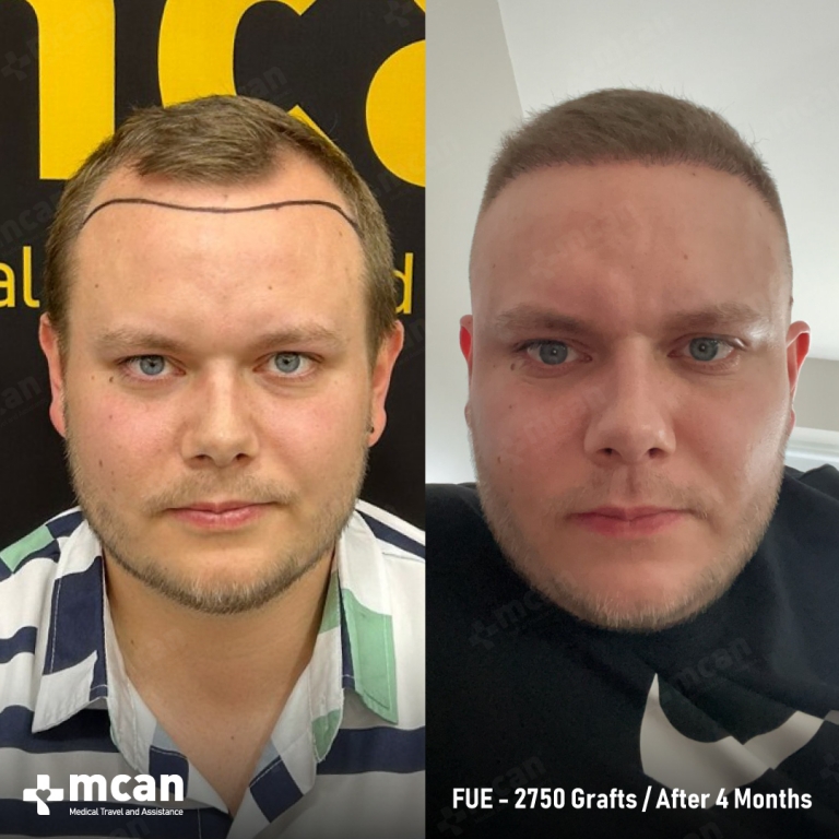 FUE Hair Transplant Before & Afters 2750 Grafts 1