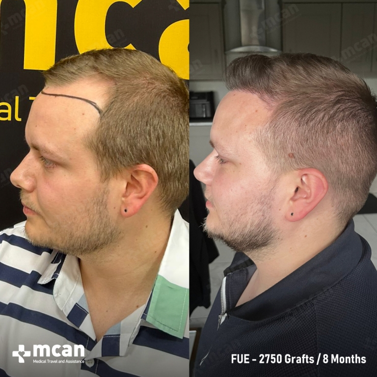 FUE Hair Transplant Before & Afters 2750 Grafts 1