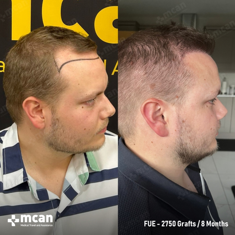 FUE Hair Transplant Before & Afters 2750 Grafts 2