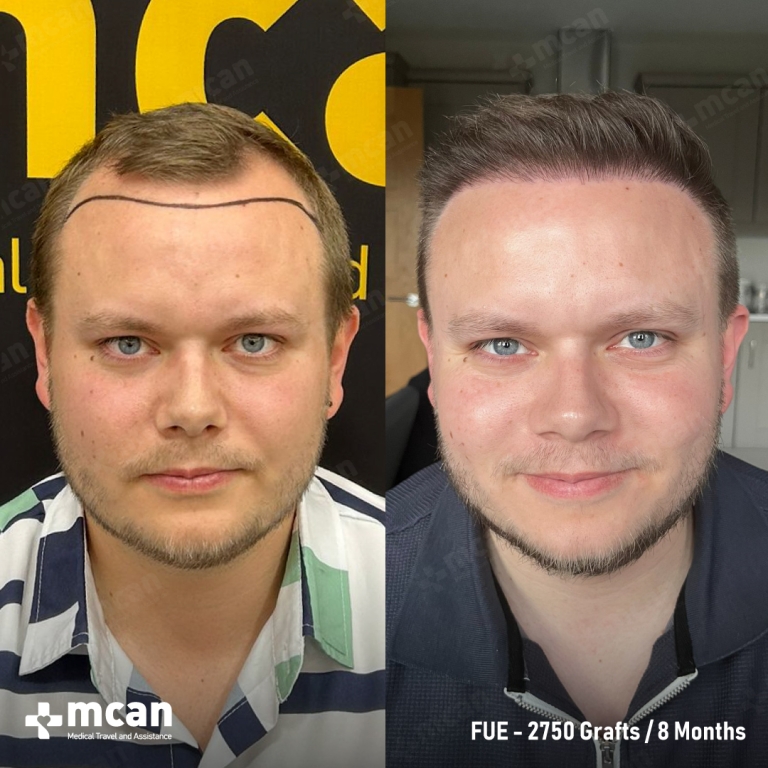 FUE Hair Transplant Before & Afters 2750 Grafts 3