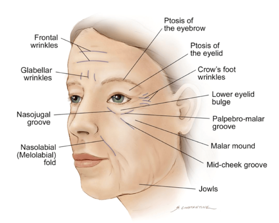 facial aging signs