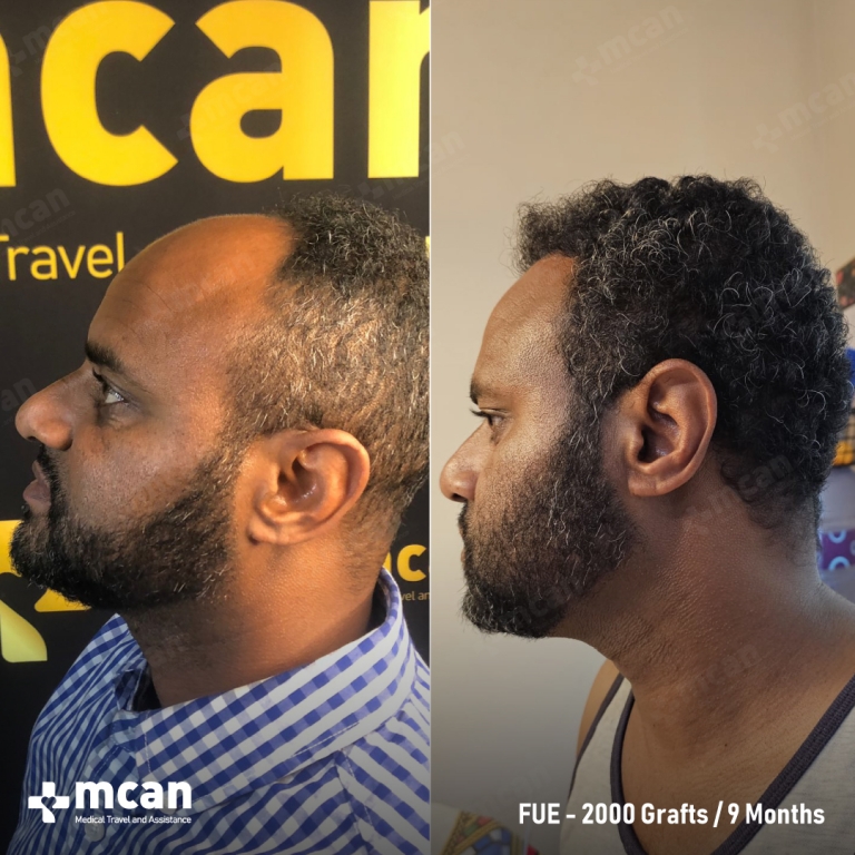 FUE Hair Transplant Before & Afters 2000 Grafts 3