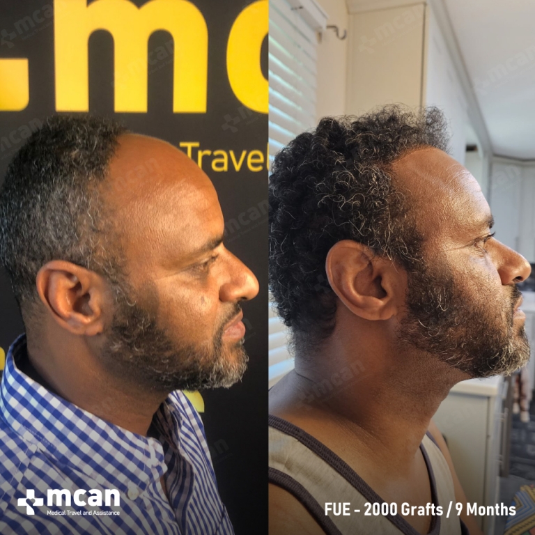 FUE Hair Transplant Before & Afters 2000 Grafts 2