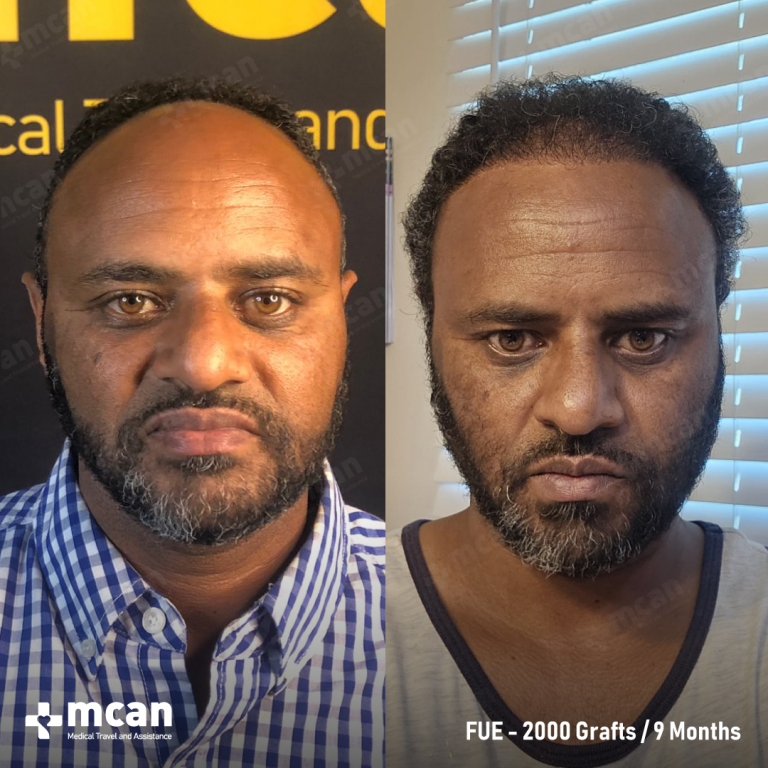 FUE Hair Transplant Before & Afters 2000 Grafts 1