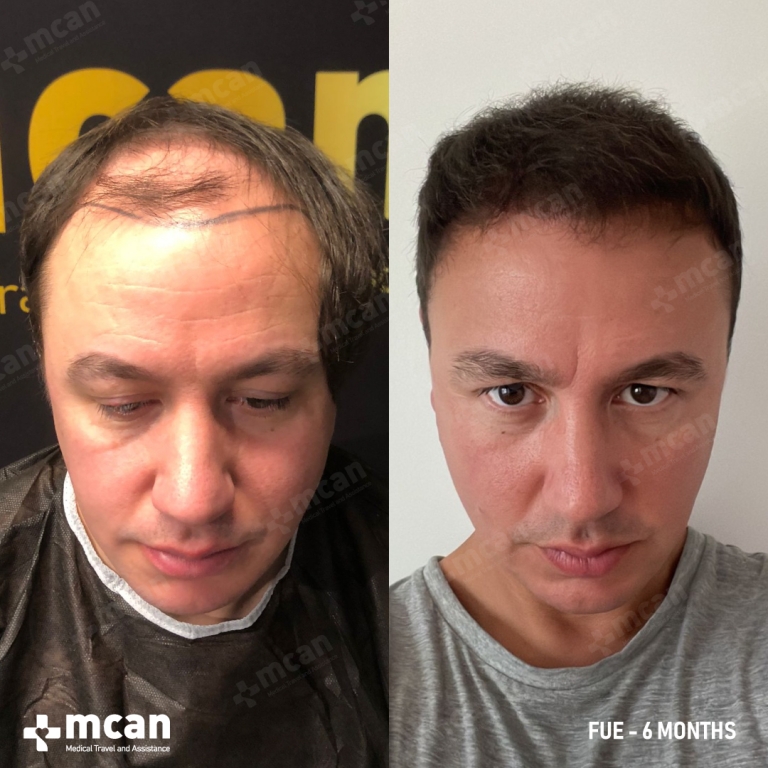 FUE Hair Transplant Before & Afters 2500 Grafts 1