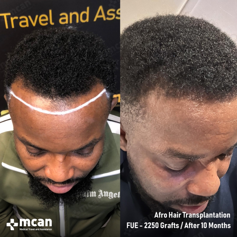 Afro Hair Transplant FUE Hair Transplant Before & Afters 2250 Grafts 1