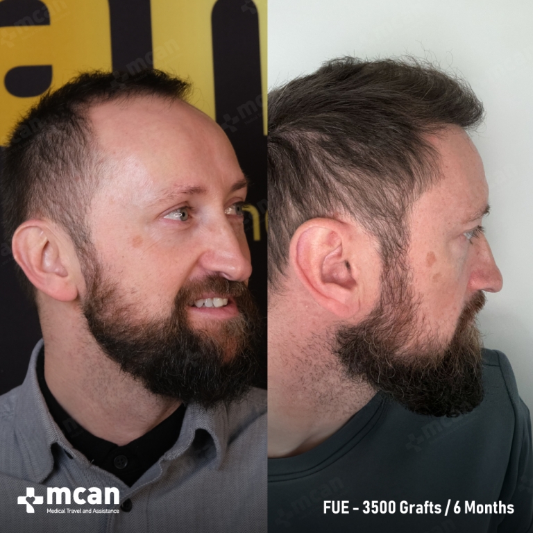 FUE Hair Transplant Before & Afters 3500 Grafts 2