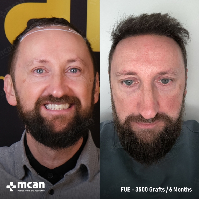 FUE Hair Transplant Before & Afters 3500 Grafts 1