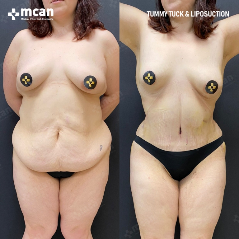 Tummy Tuck Before & Afters 1