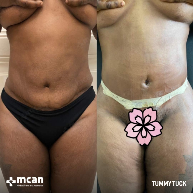 Tummy Tuck Before & Afters 1