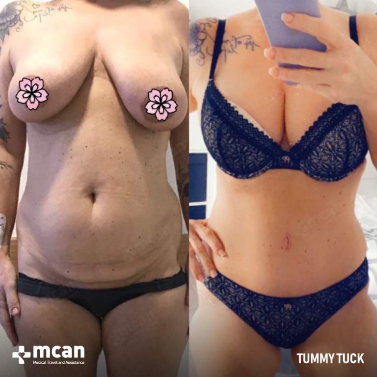 Tummy Tuck Before & Afters 1