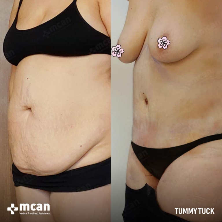 Tummy Tuck Before & Afters 1