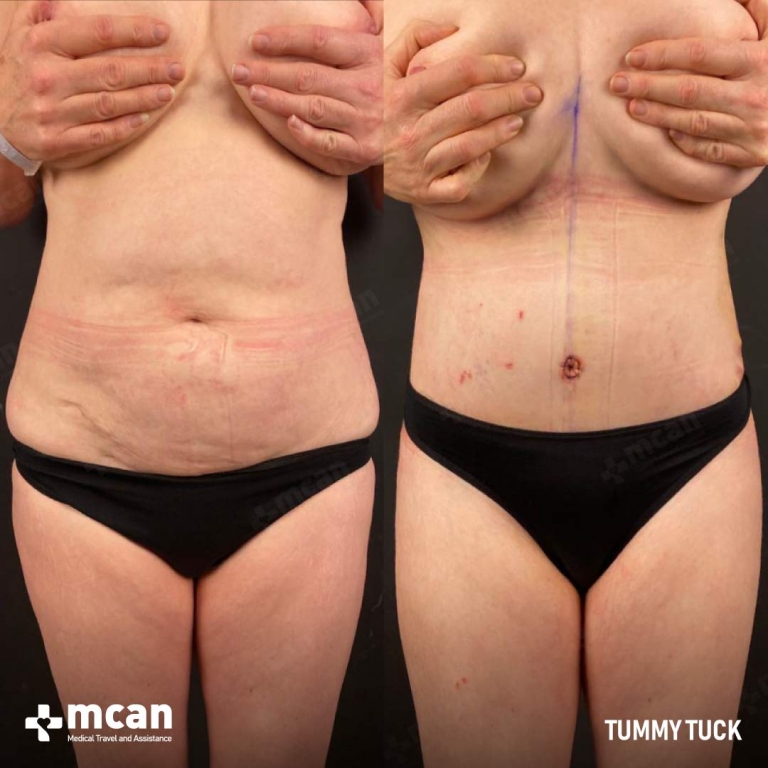 Tummy Tuck Before & Afters 1