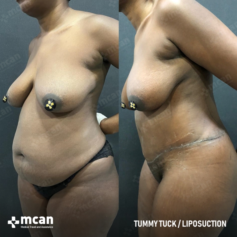 Tummy Tuck Before & Afters 1