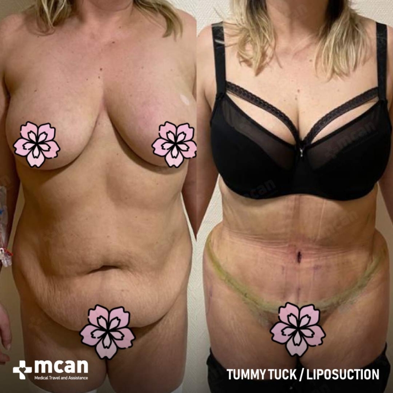 Tummy Tuck Before & Afters 1