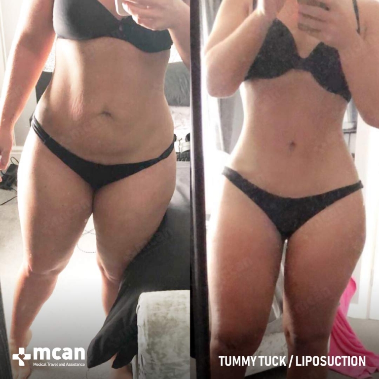 Tummy Tuck Before & Afters 1