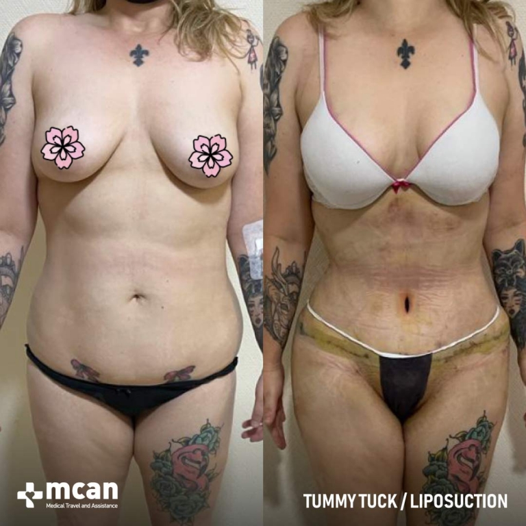 Tummy Tuck Before & Afters 1