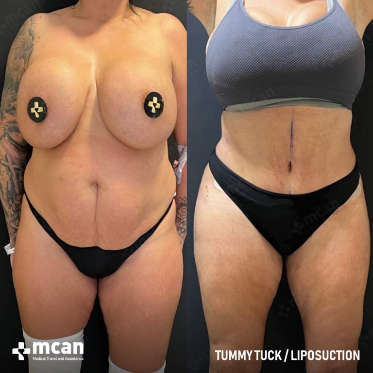 Tummy Tuck Before & Afters 1