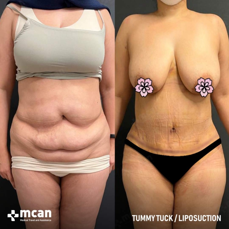 Tummy Tuck Before & Afters 1