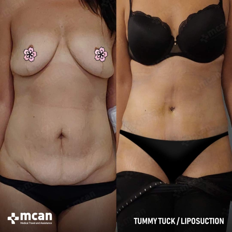 Tummy Tuck Before & Afters 1